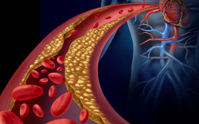 The Secrets to Lowering Your Cholesterol