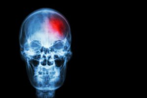 stroke ( cerebrovascular accident ) . film x-ray skull of human with red area ( medical , science and healthcare concept and background )