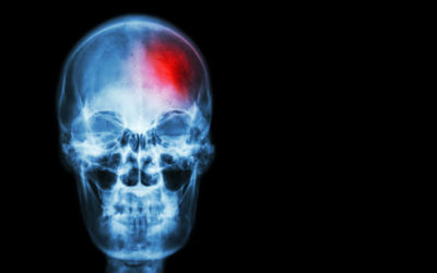 What are The Signs of a Stroke?