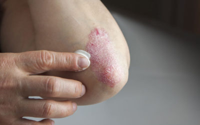 What is Psoriasis?