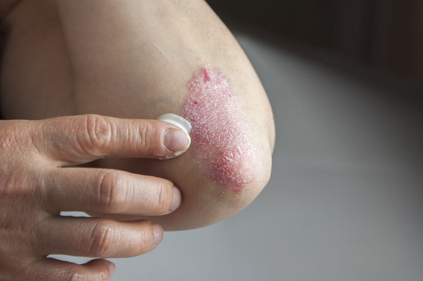 psoriasis on elbow