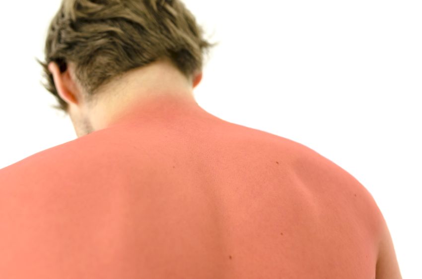man with sunburned back