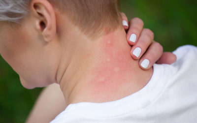 The Best Treatments for Insect Stings