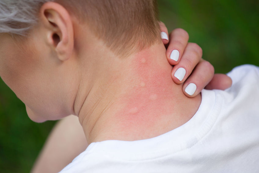 Best treatments for insect stings and bug bites