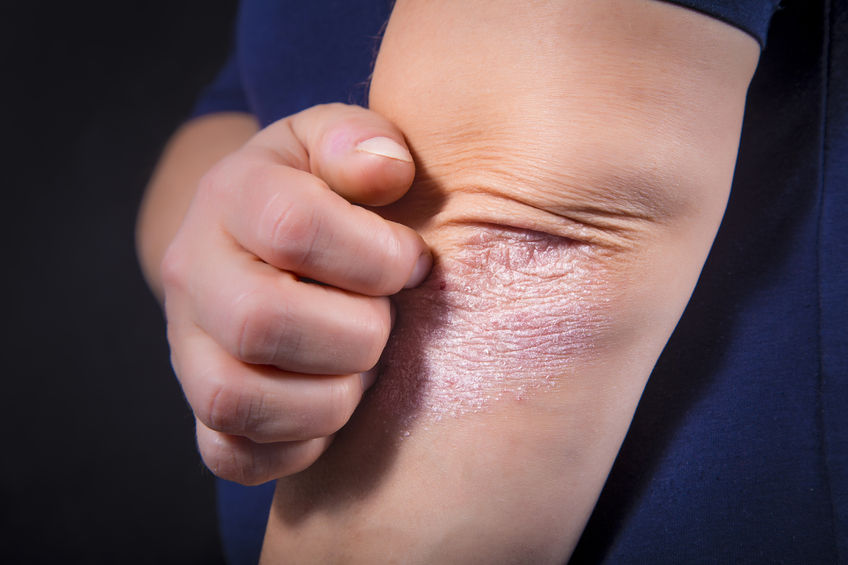 83307412 - psoriasis on lady's elbow on dark background. close up