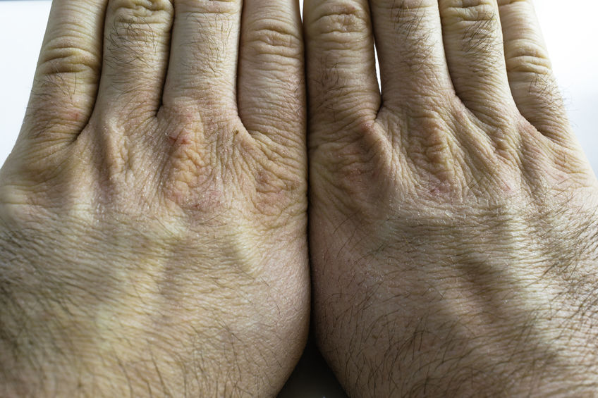 Close view of dry and rcracked hand knuckles, skin problem